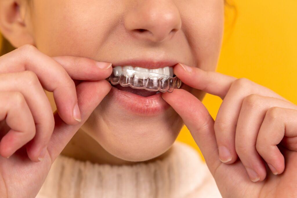 Girl putting in an Essix retainer